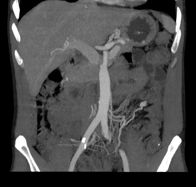 TDM abdominale, reconstruction coronale en projection d'intensité maximale
