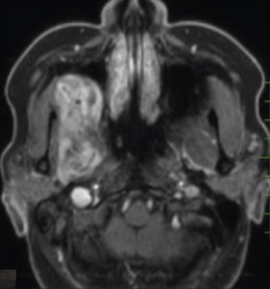 IRM axiale T1 après injection de gadolinium