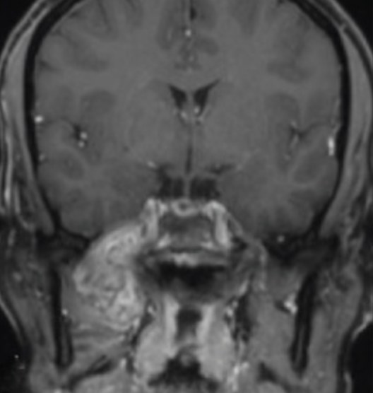 IRM coronale T1 après injection de gadolinium