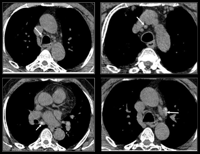TDM thoracique sans injection : ganglions médiastinaux à calcifications centrales