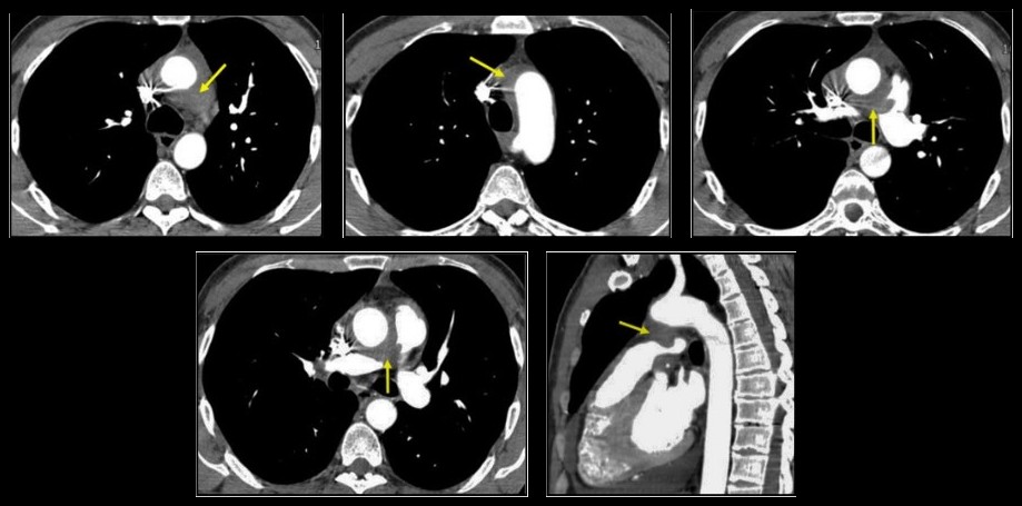 TDM thoracique injectée en fenêtre médiastinale, coupes axiales et sagittale : manchon tissulaire péri-aortique infiltrant le tronc et l'artère pulmonaire droite