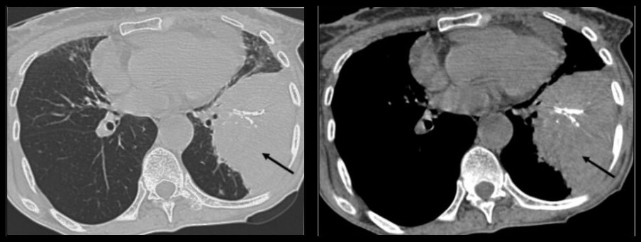TDM thoracique sans injection, fenêtres parenchymateuse et médiastinale : masse calcifiée du lobe inférieur gauche