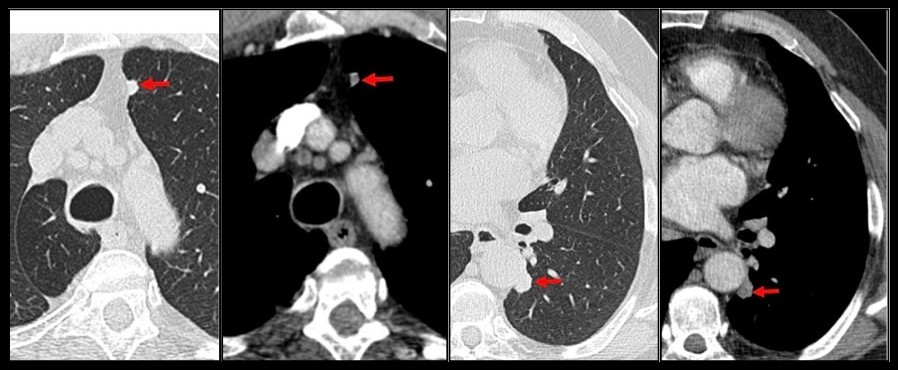 TDM thoracique injectée : deux nodules au contact de la plèvre médiastinale, à l'apex et dans le lobe inférieur gauche