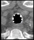 Trachée en coupe axiale : nodules calcifiés de la paroi, membrane postérieure respectée