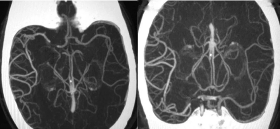 Angio-TDM cérébrale en MIP axiale et coronale : opacification du territoire de l'ACM en aval d'un thrombus