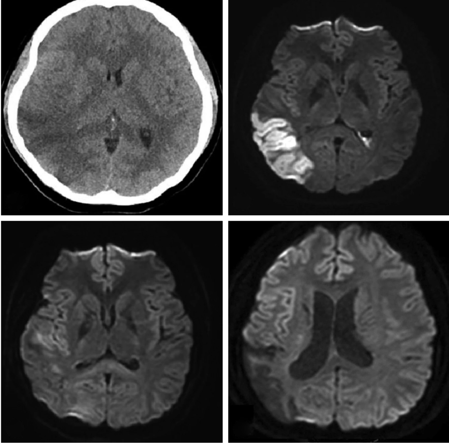 TDM sans injection et imagerie de diffusion d'un infarctus temporo-pariétal droit : jour 1, jour 10, après 4 mois