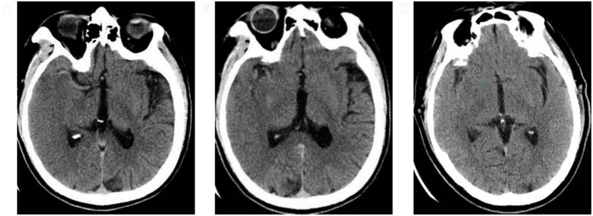 TDM sans injection, trois coupes axiales : artère cérébrale moyenne hyperdense, signe du ruban insulaire, hypodensité du noyau lenticulaire