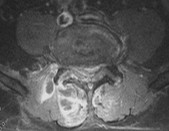 IRM axiale — arthrite interapophysaire