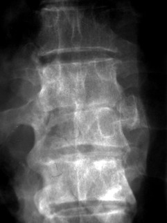Radiographie de face — hydatidose rachidienne
