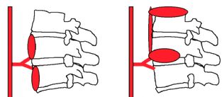 Schéma : progression sous-ligamentaire de la tuberculose