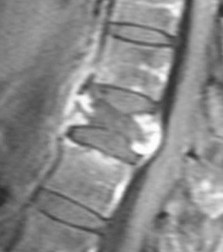 IRM sagittale injectée — spondylite tuberculeuse