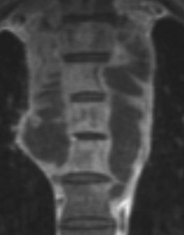 IRM coronale — spondylite tuberculeuse étagée