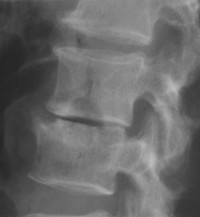 Radiographie de profil — vide discal