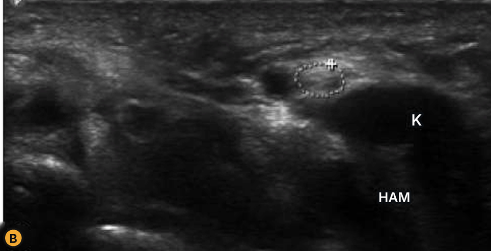 Kyste arthro-synovial entre hamulus et pisiforme avec nerf ulnaire cerclé