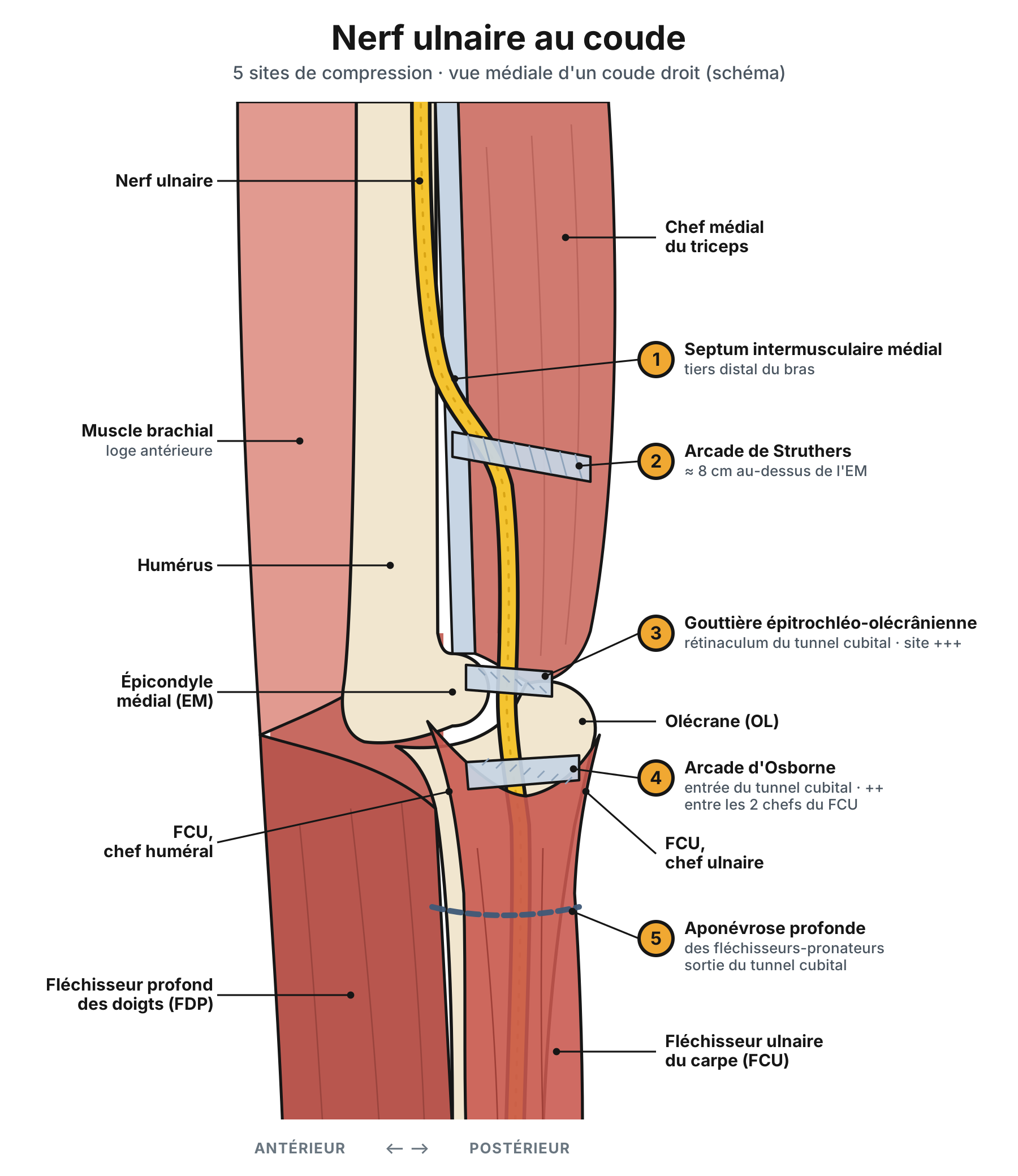 Schéma de la face médiale d'un coude droit : trajet du nerf ulnaire et ses 5 sites de compression numérotés, du septum intermusculaire médial à l'aponévrose profonde des fléchisseurs-pronateurs