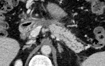 TDM à 1 an — Nécrose complète du pancréas isthmique ; discrète dilatation obstructive du CPP ; infiltrat inflammatoire de l'isthme.