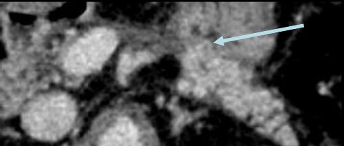 Traitement chirurgical — Pancréatectomie médiane + anastomose pancréatico-gastrique.