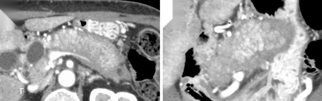 TDM : PAI diffuse avec pseudo-capsule