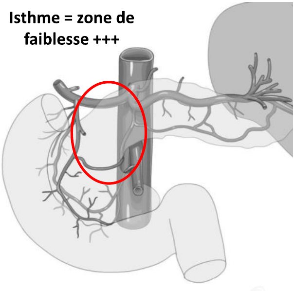 Vascularisation artérielle du pancréas — Isthme = zone de faiblesse +++ (cercle).