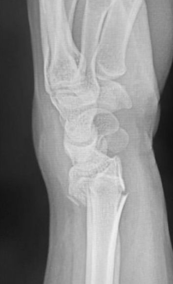 Pouteau-Colles : radiographie du poignet de profil