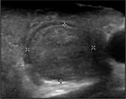 Échographie thyroïdienne : Isoéchogène