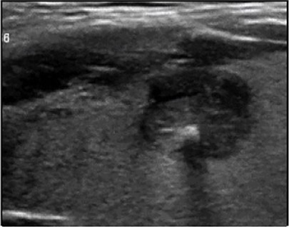 Échographie thyroïdienne : Macrocalcification (cône d'ombre)